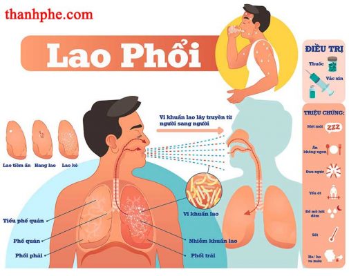Benh Ho Lao Phoi
